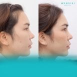 Before and after buccal fat extraction at Wansiri Hospital, slimmer cheek contour result