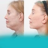 Before and after buccal fat extraction at Wansiri Hospital, improved facial contour result