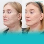 Before and after buccal fat extraction at Wansiri Hospital, slimmer facial contour result