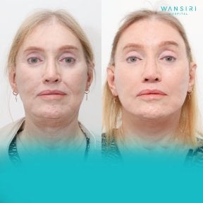 Before and after buccal fat extraction at Wansiri Hospital, slimmer facial contour result