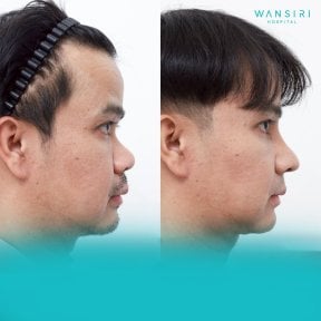 Before and after buccal fat extraction results at Wansiri Hospital, slimmer facial contour