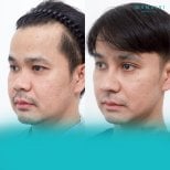 Before and after FUE hair transplant results at Wansiri Hospital, improved hairline in male patient