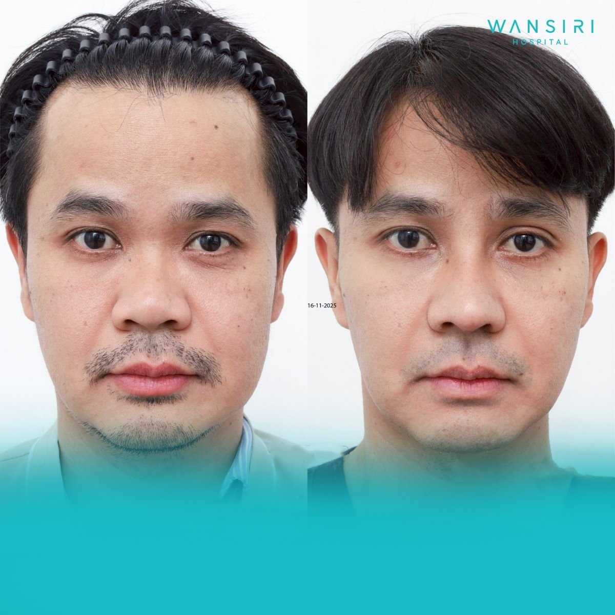 Antes y después de extracción de bolas de Bichat en Wansiri Hospital, rostro más delgado