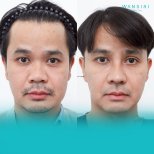 Before and after buccal fat extraction at Wansiri Hospital, slimmer facial contour result