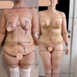 Before and after Full Body Lift photos by Dr. 