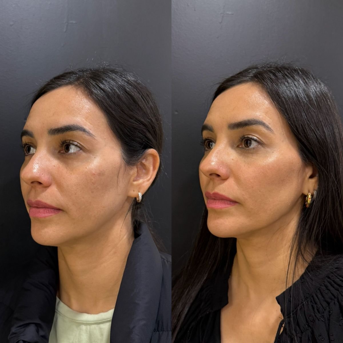 Before and after fillers injection result at Dr. Alexandro Aguilera - Plastic Surgery, facial contouring