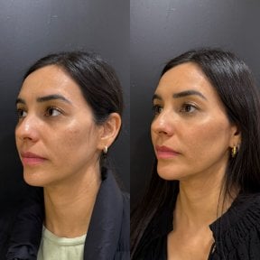 Before and after fillers injection result at Dr. Alexandro Aguilera - Plastic Surgery, facial contouring