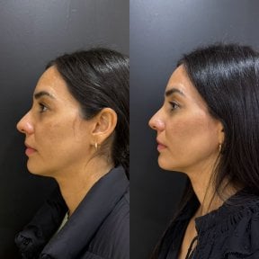 Before and after fillers injection at Dr. Alexandro Aguilera - Plastic Surgery, facial contour result