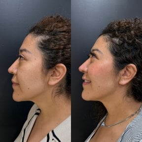 Before and after fillers injection result at Dr. Alexandro Aguilera - Plastic Surgery, facial contour