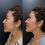 Before and after fillers injection result at Dr. Alexandro Aguilera - Plastic Surgery, facial contour