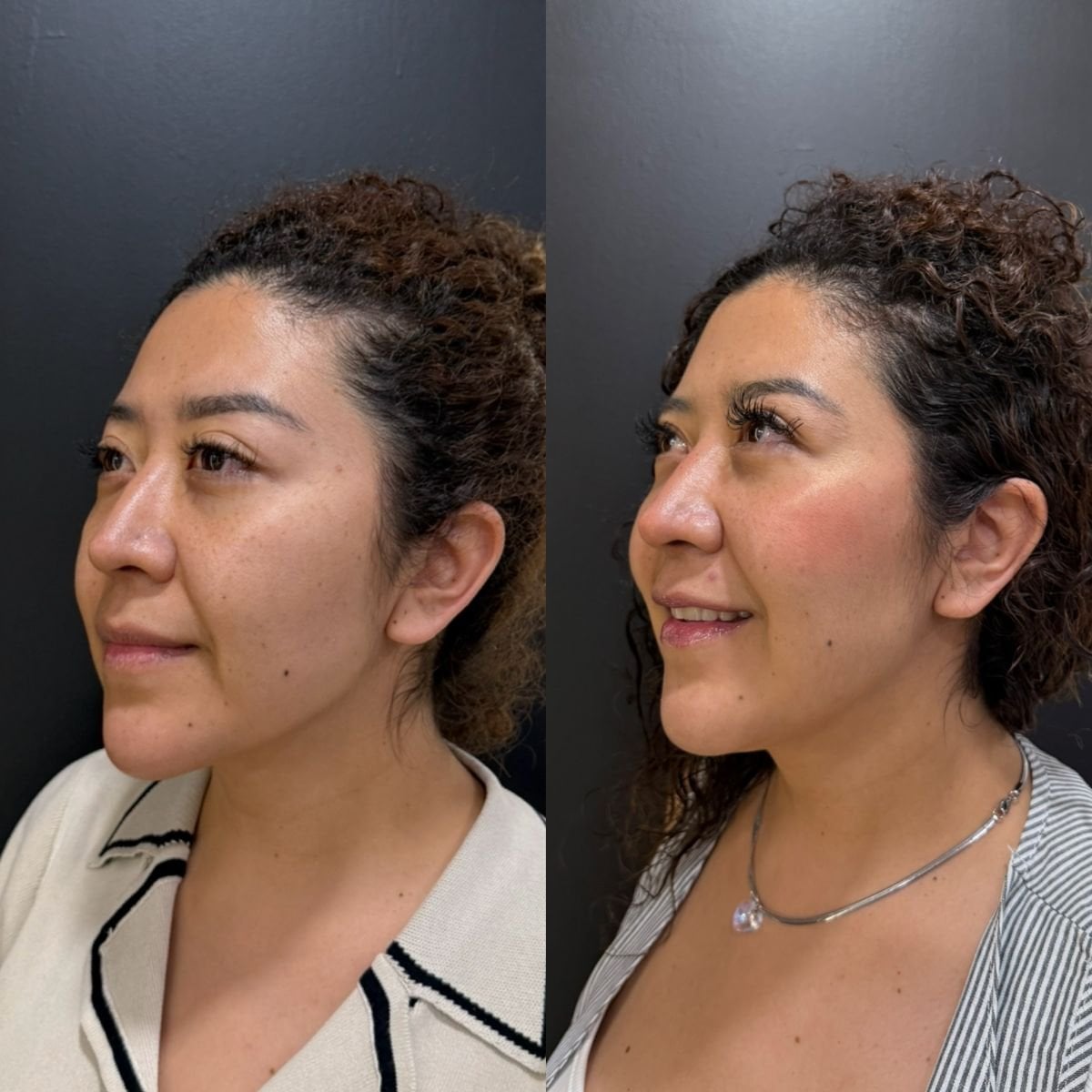 Before and after fillers injection result at Dr. Alexandro Aguilera - Plastic Surgery, facial contour