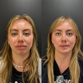 Vorher-nachher-Ergebnis Kinnimplantat bei Dr. Alexandro Aguilera - Plastische Chirurgie