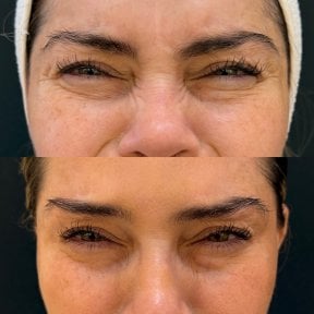 Before and after Botox injections results – reduced wrinkles around eyes and smoother skin
