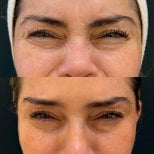Before and after Botox injections results – reduced wrinkles around eyes and smoother skin