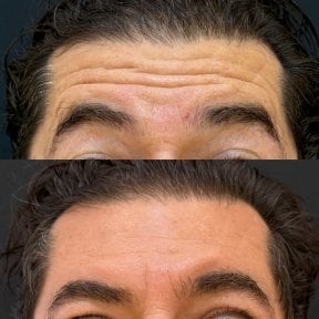 Before and after Botox injections results – smoother forehead lines and rejuvenated appearance