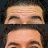 Before and after Botox injections results – smoother forehead lines and rejuvenated appearance