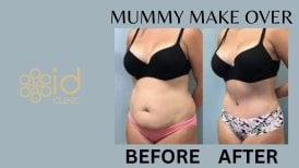 Résultats avant/après abdominoplastie à ID Clinic Bangkok, amélioration du contour abdominal