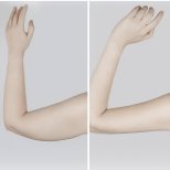 Vorher-nachher-Ergebnis Armliposuktion bei Private Yüzyıl Hospital – schlankerer Arm