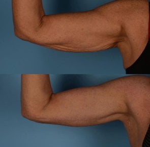 Vorher-nachher-Ergebnis Armliposuktion bei Private Yüzyıl Hospital, verbesserte Kontur