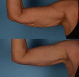 Vorher-nachher-Ergebnis Armliposuktion bei Private Yüzyıl Hospital, verbesserte Kontur