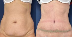 Vorher-nachher-Liposuktionsergebnis in der Private Yüzyıl Hospital, Bauchkontur verbessert