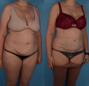 Liposuktion Vorher-Nachher-Ergebnis bei Private Yüzyıl Hospital, sichtbare Körperkonturverbesserung