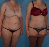 Liposuktion Vorher-Nachher-Ergebnis bei Private Yüzyıl Hospital, sichtbare Körperkonturverbesserung