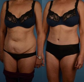 Vorher-nachher-Liposuktionsergebnis bei Private Yüzyıl Hospital, verbesserte Bauchkontur