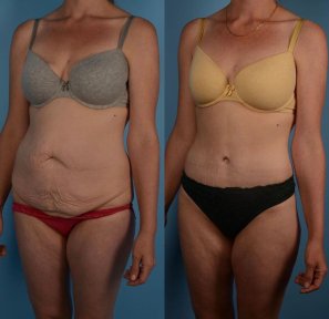 Vorher-nachher-Liposuktionsergebnis in Private Yüzyıl Hospital – verbesserte Bauchkontur