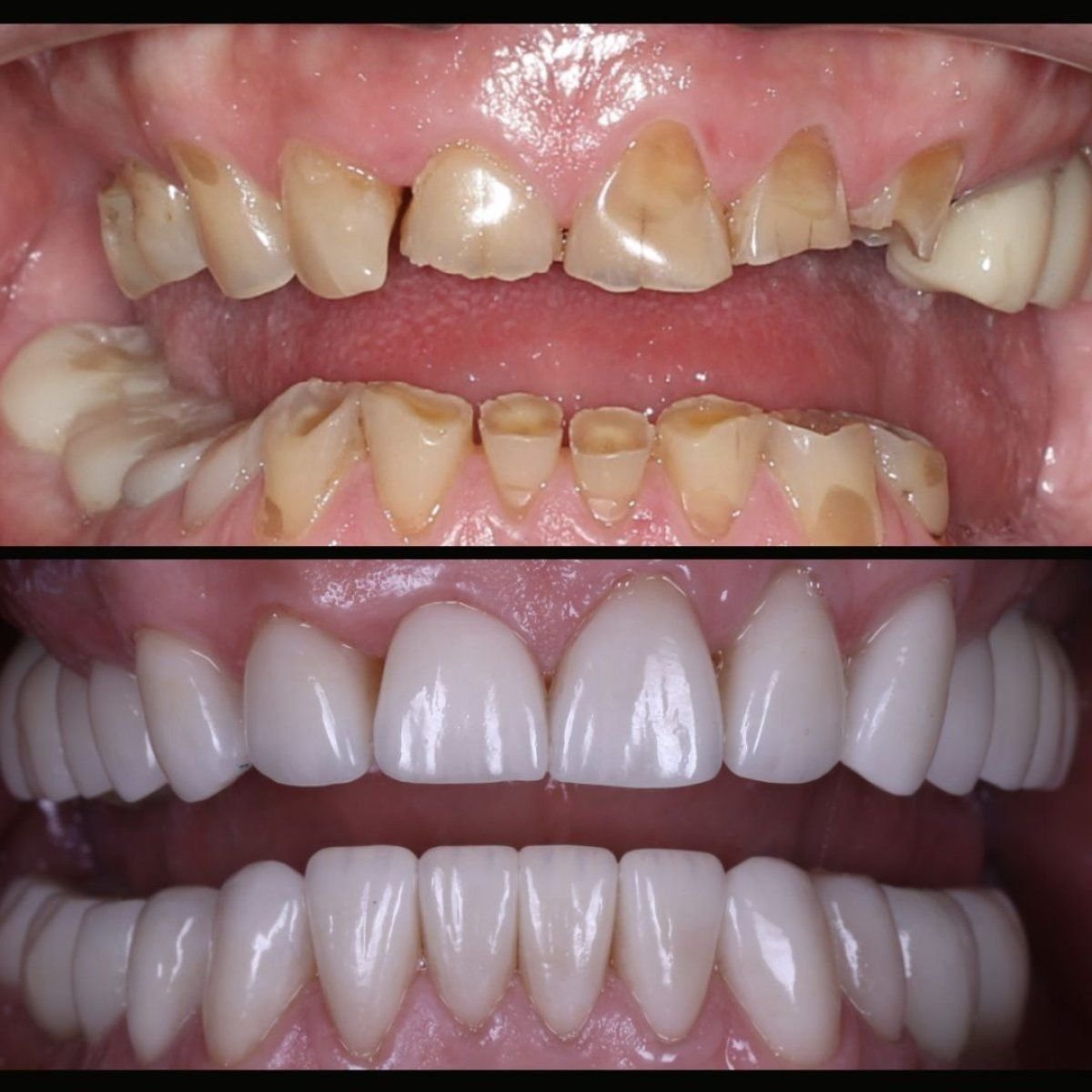 نتائج قبل وبعد هوليوود سمايل في Smile Centrum – تحول الابتسامة بالفينير