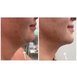 Результат до и после Vaser-липосакции подбородка в Meliva Kardiolita Hospital