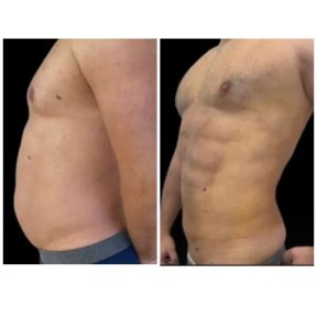 Before and after Vaser liposuction results at Meliva Kardiolita Hospital, improved abdominal contour