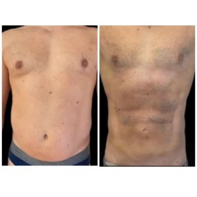 Before and after Vaser liposuction results at Meliva Kardiolita Hospital, defined abs contour