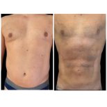 Before and after Vaser liposuction results at Meliva Kardiolita Hospital, defined abs contour