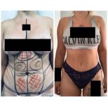 Before and after Vaser liposuction results at Meliva Kardiolita Hospital, improved body contour
