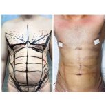 Before and after Vaser liposuction results at Meliva Kardiolita Hospital, defined abs contour