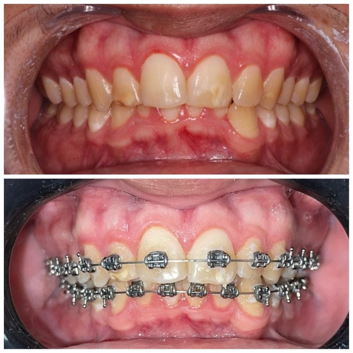 قبل وبعد علاج التقويم في Clinica Dental Pujols Rodriguez، نتيجة تصحيح الأسنان