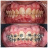 Before and after braces treatment at Clinica Dental Pujols Rodriguez, teeth alignment result