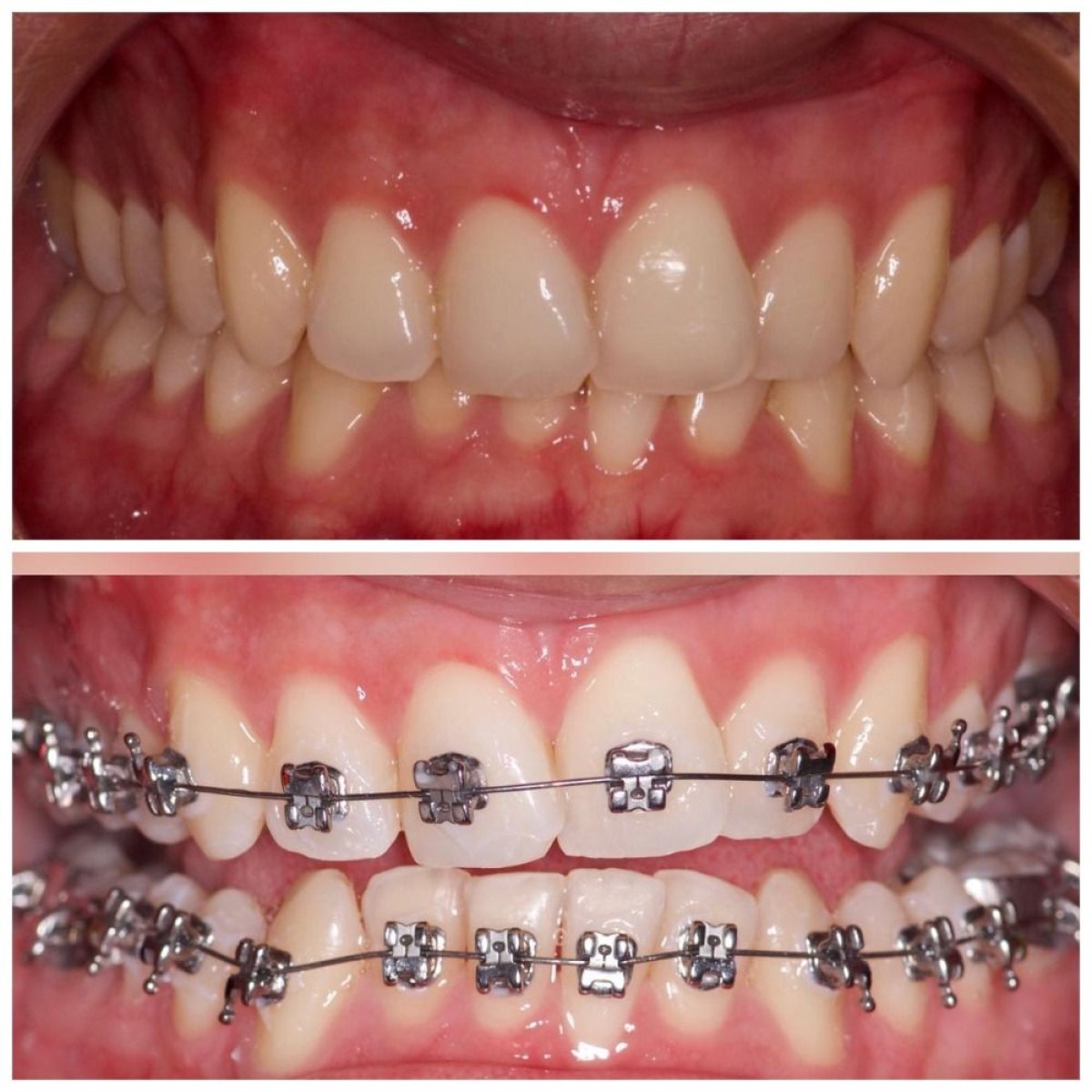 نتائج قبل وبعد علاج التقويم في Clinica Dental Pujols Rodriguez لتقويم الأسنان