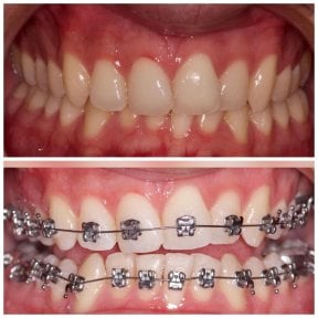 Before and after braces treatment results at Clinica Dental Pujols Rodriguez for teeth alignment