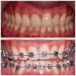 Before and after braces treatment results at Clinica Dental Pujols Rodriguez for teeth alignment