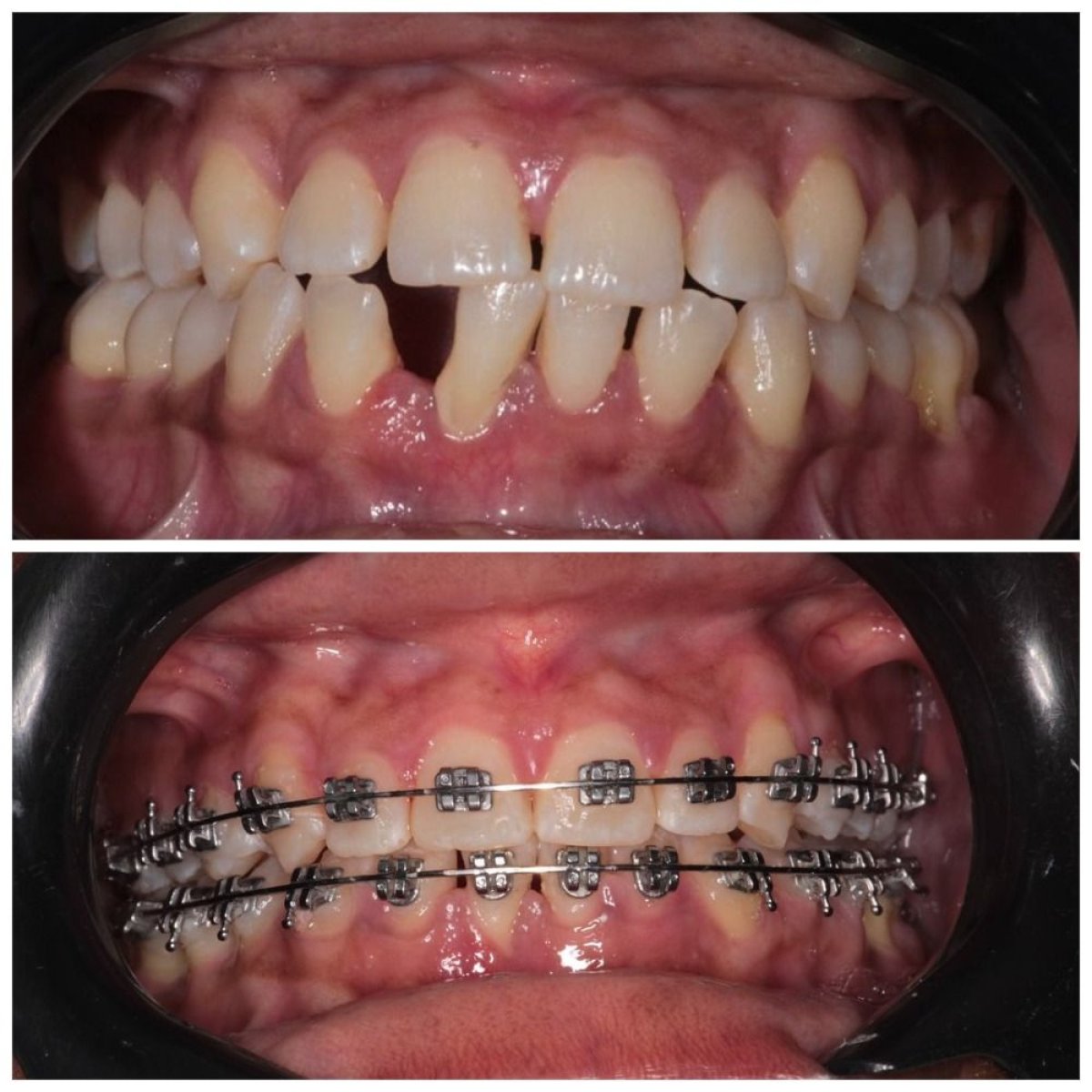 قبل وبعد علاج التقويم في Clinica Dental Pujols Rodriguez، نتيجة تصحيح الأسنان