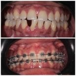 Before and after braces treatment at Clinica Dental Pujols Rodriguez, teeth alignment result