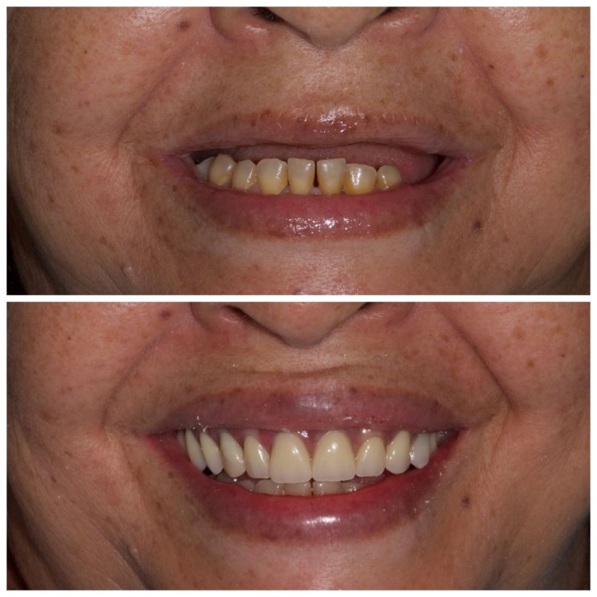 Resultado antes y después de implantes All-on-6 en Clinica Dental Pujols Rodriguez, sonrisa restaurada