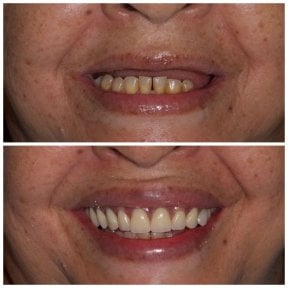 Résultat avant/après implants All-on-6 à Clinica Dental Pujols Rodriguez, sourire restauré