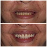 Résultat avant/après implants All-on-6 à Clinica Dental Pujols Rodriguez, sourire restauré