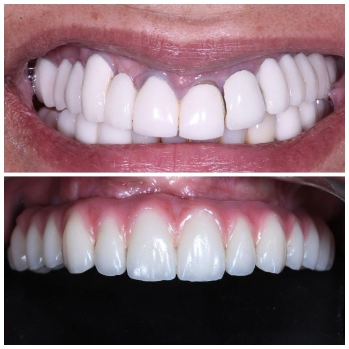 نتائج قبل وبعد زراعة الأسنان All-on-6 في Clinica Dental Pujols Rodriguez، استعادة الابتسامة