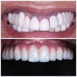 Résultat avant/après implants All-on-6 à Clinica Dental Pujols Rodriguez, restauration du sourire