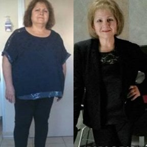 Результати до і після встановлення шлункового бандажа в Centro Médico Teknon, значне схуднення