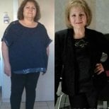 Dr.  тарапынан Метаболикалық хирургия бұрын және кейін фотосуреттері